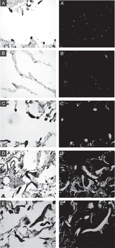 Figure 2 Altered distribution and abundance of cells expressing α-SMA in CBO lung. Serial sections of lung were stained with Hart’s elastin stain (left panels) or for a-SMA (right panels). A: Alveolar section from a control lung specimen showing focal elastic fibers (black stained) at tips of alveolar walls (grey counterstain). A′: Serial section stained for a-SMA shows small alveolar myofibroblasts localizing to alveolar tips. B: Emphysematous lung specimen with diminished complexity, enlarged airspaces, and less elastin staining. B′ shows loss of focal staining for a-SMA. C: Alveolar region from CBO lung shows large focal elastic fibers at alveolar septal tips, and C′ shows enlarged myofibroblasts at the same sites staining intensely for a-SMA. D and E: Remodeled regions of CBO lung showing accumulation of thick elastic fibers. D′ and E′: The elastic fibers are surrounded by cells staining intensely for a-SMA.