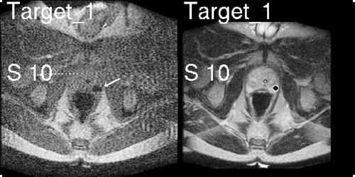 Figure 2. Images displayed to the physician during the procedure: FSE real-time image (left) showing needle artifact (arrow), and T2-weighted pre-procedure image (right) with a target marked in the peripheral zone. Distance to the target (superior 10 mm) is also displayed.