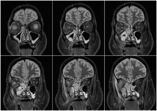Figure 1. Preoperative coronal MRI with gadolinium contrast. MRI showing a destructive lesion with bony involvement of the right pterygoid and sphenoid wings, soft tissue enhancement of the right orbit, and left optic nerve atrophy.