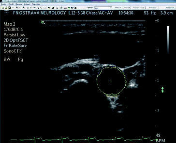 Figure 5. Example of the cross-section of the artery with highlighted object inside the measuring application.