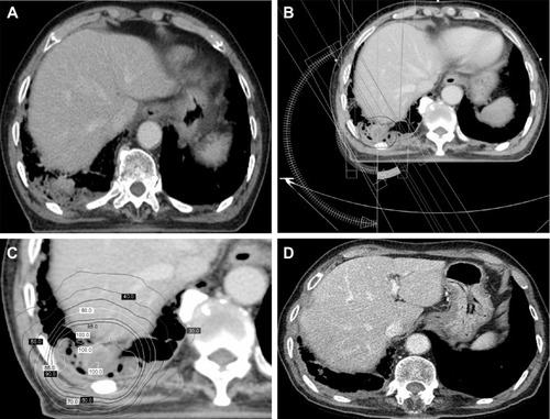 Figure 1 Pretreatment 2.5 cm contrast-enhancing mass in the right lower lobe (A). Volumetric modulated arc therapy plan with the planning target volume (B). Dose distribution with isodose lines, from 100% to 30% (C). Complete tumor response 2 months after treatment (D).