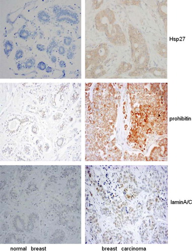Figure 5. Representative immunohistologic features of Hsp27 (A), prohibitin (B) and laminA/C (C) in normal breast and breast carcinoma (original magnification 200).