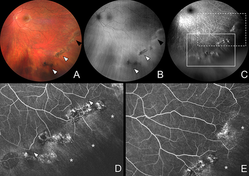 Figure 2 Multimodal imaging in lattice degeneration. (A) Color fundus photography demonstrates multiple concentrical mildly pigmented (white arrowheads) and nonpigmented (black arrowhead) lesions. (B) Green-light fundus autofluorescence shows hypointense signal from mildly pigmented lesions (white arrowheads) and hyperintense signal (black arrowhead) from nonpigmented lesion. (C) Wide-field fluorescein angiography shows granular fluorescence of multiple lesions. White box indicates position of image in (D). Dashed box indicates position of the image in (E). (D) High-magnification image captured in early phase of fluorescein angiography shows loss of terminal vessels (arrowheads) and peripheral retinal nonperfusion behind the lesions (asterisks). (E) High-magnification image captured in early phase of fluorescein angiography shows peripheral retinal nonperfusion behind the lesions (asterisks).