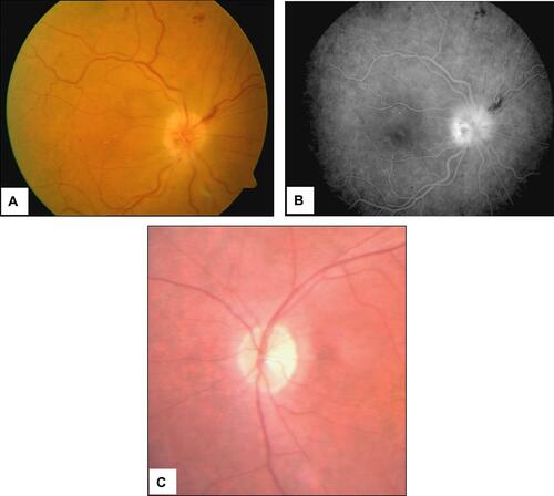 Figure 7 Scanning laser ophthalmoscopy and fluorangiography patterns in a GCA patient with acute ischemia of the papilla. Pale colored edema and light swelling are evident on the optic disc (panels A and B). Four months later the pattern changed to optic nerve atrophy (panel C). 