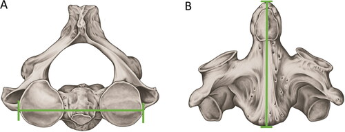 Figure 4. Metric analyses with statistical significance in sex estimation — axis. (A) Maximum amplitude between the upper articular faces. (B) Maximum sagittal length. Both measurements showed the highest discriminant values for sex estimation according to the Wescott method.