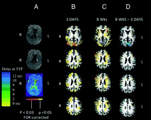 Figure 6. Panel A: DWI and PWI at Day 1 for Participant 3. Panel B: Activation associated with picture naming for Participant 3 at Day 3. Panel C: Activation associated with picture naming at 8 weeks. Functional magnetic resonance imaging (fMRI) activation maps are false discovery rate (FDR) corrected for multiple comparisons and are displayed with a threshold of p < .05. Panel D: A difference statistical map shows activation that is greater at 8 weeks than 3 weeks in yellow, and activation that is greater at 3 weeks than 8 weeks in blue. [To view this figure in colour, please see the online version of this journal.]