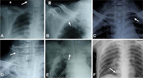 Figure 2 Several common misplacements of central venous catheter tips.