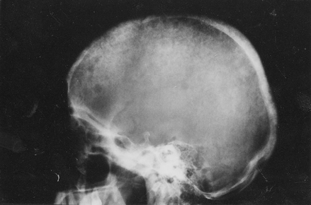 Figure 5. Trabecular bone resorption of the cranium.