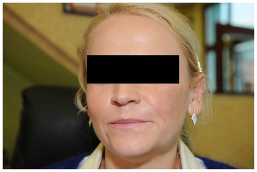 Figure 4 Patient’s appearance after injection of 2 mL of hyaluronic acid into her left cheek.