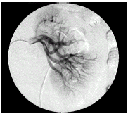 Figure 2. Follow-up angiogram after intra-arterial thrombolytic therapy shows complete lysis of the thrombus and good reperfusion of the left renal mid-portion arterial branches.