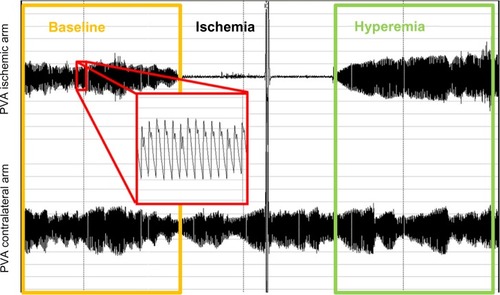 Figure 1 Recording from a peripheral arterial tonometry test. The baseline period is highlighted in yellow box, and the hyperemic period is highlighted in green. A magnified detail of PVA is highlighted in red.