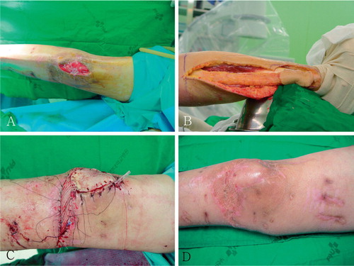 Figure 3. A. A 40-year‐old man with a prepatellar area skin defect of the right leg as a result of open fractures of the femur and tibia. B. A proximally based superficial sural artery flap, which was 6 cm x 10 cm in size with a 20-cm pedicle length, was elevated. C. After dividing the subcutaneous tunnel in order to reduce tension to the pedicle, a split‐thickness skin graft was conducted on the short segment of the pedicle in the medial aspect of the knee, where the skin and subcutaneous tissue were scarred and fibrosed. D. The patient was satisfied with this thin sensate flap at the 30-month follow‐up examination.