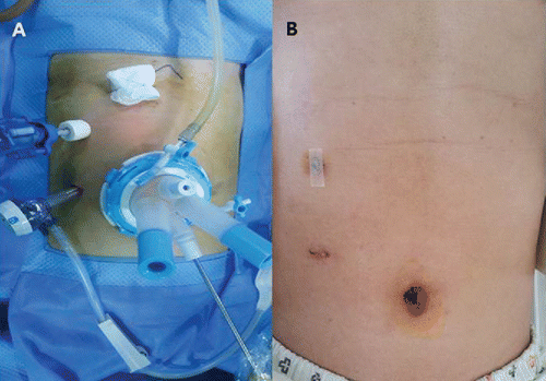 FIGURE 1 (A) The port locations for TP-LDG are shown. The assistant's instruments and endoscope are introduced through an OCTO™ Port (DalimsurgNET, Seoul, Korea) in the umbilicus. The Operator's laparoscopic instruments are introduced through the ports in the right side of the abdomen. (B) The appearance of the wound 14 days after TP-LDG is shown.