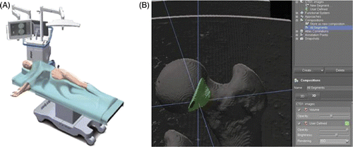 Figure 4. Navigated surgical resection of the cam lesion based on structural analysis of the femur. (A) Patient set-up and (B) graphical user interface, including 3D planning tools that provide information on the size of the lesion and the location of the surgical tool in relation to it.