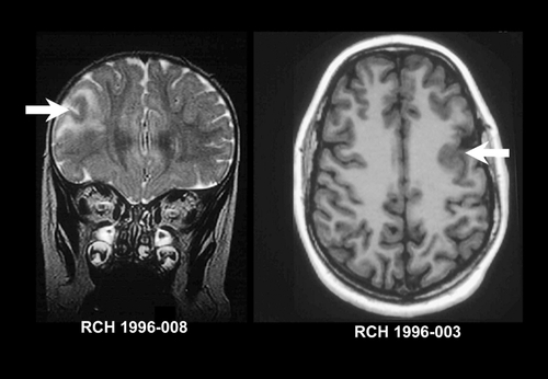 Figure 2. Imaging features of focal cortical dysplasia. Coronal T2weighted MRI (left) and axial T1 -weighted MRI (right) of two patients with focal cortical dysplasia. The image on the left shows area of gyral irregularity and increased subcortical signal (arrow) consistent with cortical dysplasia with signal change. The image on the right shows an area of unusual gyral formation and underlying thickening and blurring of the gray-white junction (arrow) consistent with cortical dysplasia without signal change. (No signal increase was seen on T2 weighted images.) MRI, magnetic resonance imaging