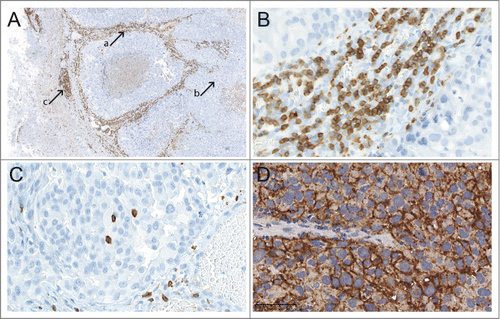 Figure 2. A TIL distribution between different areas (CD3+ TILs, magnification ×5); B TIL density within the tumor stroma (CD3+ TILs, magnification ×200); C TIL density within the solid tumor (CD3+ TILs, magnification ×200); D PD-L1 expression in a melanoma BM (magnification ×200).