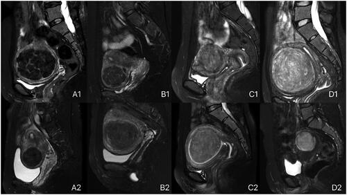 Figure 2. Classification of uterine fibroids on the basis of T2-weighted MR images. A1: heterogeneous extremely hypointense fibroids; A2: homogeneous extremely hypointense fibroids; B1: heterogeneous hypointense fibroids; B2: homogeneous hypointense fibroids; C1: heterogeneous isointense fibroids; C2: homogeneous isointense fibroids; D1: heterogeneous hyperintense fibroids; D2: homogeneous hyperintense fibroids.