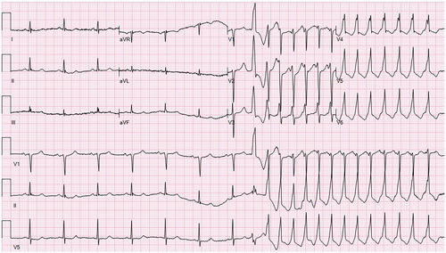 Figure 2. Patient’s EKG.