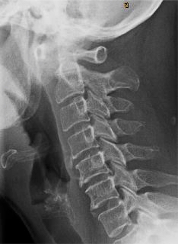 Figure 4 Lateral cervical spine standing X-ray after 3 weeks of non-operative management showing persistent increased atlanto-dens interval.