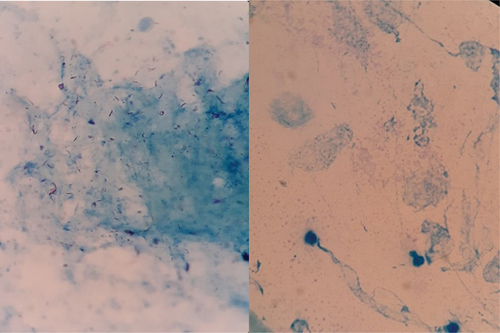 Figure 3. Microscopic slide image. Left: Positive. Right: Negative tuberculosis.