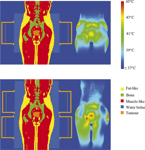 Figure 7. An example of the resulting temperature distribution (right) after temperature-based optimisation with the corresponding coronal slices (left) for the AMC-4 system (top) and the AMC-8 system (bottom).