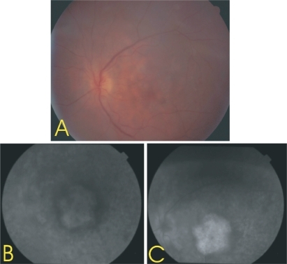 Figure 2 Dense cataract obscures details. A) Color fundus photograph of the left eye five months after the intavitreal injection of Avastin® in the right eye. B, C) Fluorescein angiography five months after the intavitreal injection of Avastin® in the right eye.