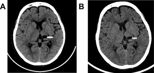 Figure 1 Cranial CT (A) upon presentation and (B) 9 months after stellate ganglion block. White arrows: lesions.