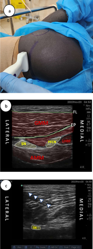 Figure 3 Subgluteal approach of Sciatic Nerve and Posterior Femoral Cutaneous Nerve at gluteal crease. (a) Probe position and landmarks. (b) Sono-anatomy. (c) Needle progression towards the posterior femoral cutaneous nerve (PFCN).