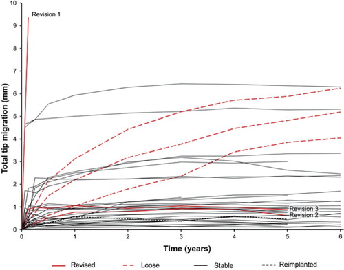 Figure 4. Total tip migration of 35 CUT prostheses. Represented are: 3 failures (solid red lines), 3 prostheses showing continuous excessive migration (dashed red lines), 29 stable unrevised prostheses (solid black lines), and 1 CUT prosthesis of larger size implanted in revision case 1 (dashed black line; see Table 1 for details).