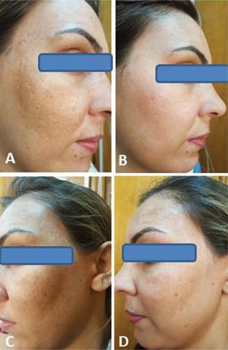 Figure 1 A 35-year-old female patient with a 4-year history of melasma: (A) before treatment with fractional Er:YAG laser + HQ cream, (B) clinical appearance 12 weeks after starting therapy, (C) before treatment with HQ cream alone, and (D) clinical appearance 12 weeks after starting therapy.