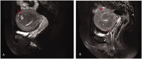 Figure 1. Classification of adenomyosis based on MRI: the ill-demarcated low intensity area represents adenomyosis (red arrow heads) that had developed in the thickened junctional zone and that healthy muscular structures were preserved outside the adenomyosis. A. asymetric internal adenomyosis; B. symmetric internal adenomyosis.