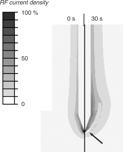 Figure 5. Electrical RF current density for cooled needle electrode at beginning of ablation (left) and after 30 s (right). Due to tissue vapourization around 100°C, current density drops after 30 s around the electrode tip (arrow), since at this location temperatures above 100°C are obtained first. Current density is shown as percentage of maximum. Grey circle represents tumour boundary.