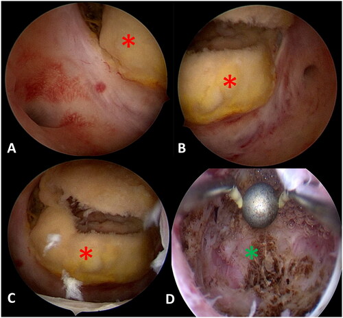 Figure 3. The procedure of hysteroscopic myomectomy for a 39-year-old patient with a large submucosal fibroid pretreated by HIFU. The operation time was 30 min. The distention fluid deficit was 150 ml and the blood loss was 20 ml. (A–C) Hysteroscopic images showed the surface of the treated fibroid before hysteroscopic myomectomy (red asterisks). (D) A hysteroscopic image showed the fibroid was resected completely (green asterisk).