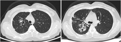 Figure 1 Chest CT image of the patient showed multiple dilatation of the bronchi with infection in the right lung. As shown by the arrow, aspergilloma can be seen in the dilated bronchus, showing air crescent sign.