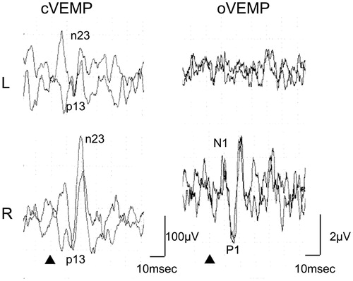 Figure 3. VEMP responses of Patients #3. He had decreased amplitudes of cVEMP on the left (AR = 50.0) and showed absence of oVEMP responses to the left ear stimulation. Stimuli were 500 Hz air-conducted short tone bursts (125 dBSPL) ▴: STB presentation.