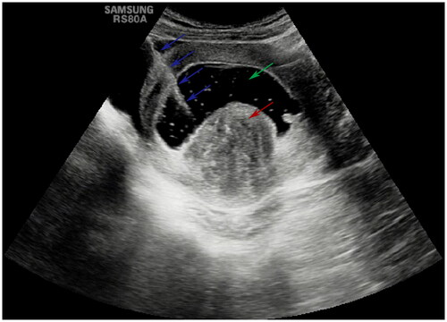 Figure 1. The schematic diagram of percutaneous intrauterine instillation of chilled saline under the ultrasonic guidance for microwave ablation treating uterine fibroid adjacent to the endometrium. The submucous fibroid (red arrow); the 18 gauge puncture needle (blue arrows); the uterine cavity filled with chilled saline (green arrow).