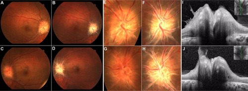 Figure 1 Fundus photographs of the right eye (A and B) and left eye (C and D), and photographs focused on the optic disc of the right eye (E and F) and left eye (G and H) taken in 2009 and 2012, respectively. spectral-domain optical coherence tomography scans of the optic disc in the right eye (I) and left eye (J) in 2012. (A–D) Fundus photographs show obvious bilateral optic disc swelling, and absence of vitreous opacifications and retinal exudates. (E and F) Fundus photographs focused on the optic disc reveal the lack of a sharp outline to the redness of the optic discs, and retinal vascular sheathing around the optic discs. There are no dilated superficial capillaries and hemorrhages on optic discs as was observed in 2009. (G and H) Both optic discs were white in color and retinal vascular sheathing was increased after 3 years. (I and J) Longitudinal scans of the optic discs showing obvious optic disc swelling.