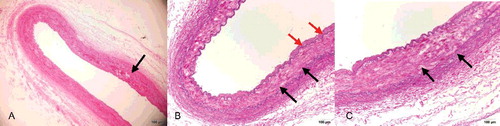 Figure 4. (A) Renal artery vessel alterations were seen in the media in areas with thick intima and fibroplasia with disorganization of smooth muscle cells (black arrow) (HE×4). (B) In the renal arteries, alterations in the media were seen in areas with thick intima (red arrows), fibroplasia with disorganization of smooth muscle cells and loss of elastica in the muscularis (black arrows) (EvG×4). (C) Higher-power view of the renal artery showing fibroplasia with disorganization of smooth muscle cells and loss of elastica in the muscularis (black arrow) (EvG×10).