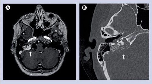 Figure 2. Imaging characteristics of endolymphatic sac tumors.(A) Axial postcontrast T1-weighted MRI and (B) axial noncontrast high-resolution CT scan through the right temporal bone demonstrating endolymphatic sac tumor (arrows) with bony erosion of the petrous temporal bone.
