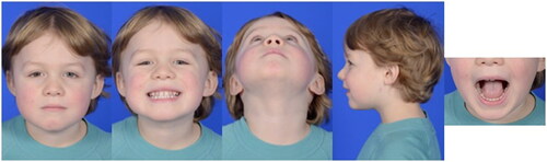 Figure 6. The patient’s clinical photographs at 5-month follow up showing facial symmetry, class I occlusion (pre-injury normal occlusion), full oral excursion, and nearly imperceptible scarring at the left transfacial pin placement site.