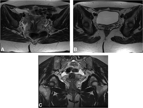 Figure 2 Case of complete septate uterus and vagina down to introitus, categorized by ASRM and ESHRE systems. (A and B) Axial T2W images showing the complete septate uterus and vagina. (C) Coronal T2W image showing the septate cervix and the two vaginae.