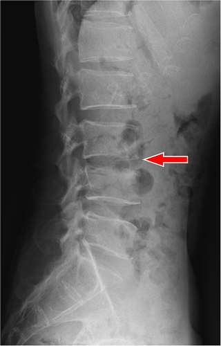 Figure 2 X-ray image of pre-operative.