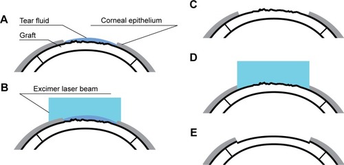 Figure 1 Steps of wet transepithelial phototherapeutic keratectomy (TE-PTK) in the management of persistent epithelial defects in the graft.