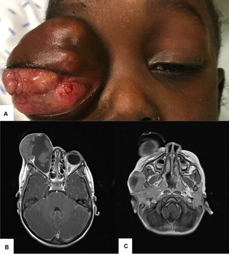 Figure 2 Unilateral advanced Retinoblastoma presenting with aggressive orbital invasion (A) and central nervous system involvement seen in the magnetic resonance imaging (B and C). Only supportive palliative treatment was offered.