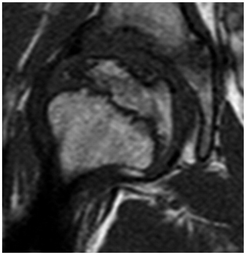 Figure 7. At 2 years. 90% re-ossification. Stage IIIb.