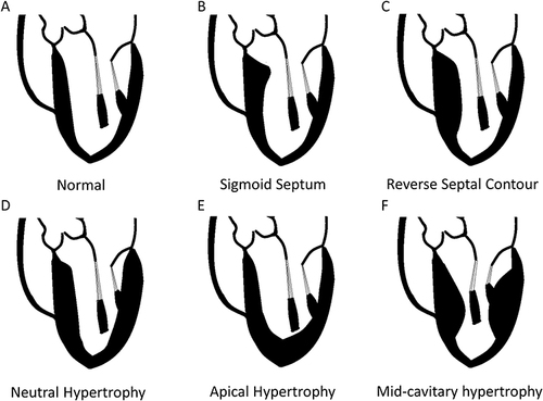 Figure 1 Phenotypic subtypes of hypertrophic cardiomyopathy, differentiated by region of hypertrophy. (A) Representation of a normal human heart. (B) Type A/type I hypertrophy results in a sigmoid septum with discrete hypertrophy of the basilar septum with less severe hypertrophy of the basolateral wall. (C) Type B/Type II hypertrophy involves the majority of the basilar septum and in three dimensions spirals anteriorly as it tracts down to the apex. (D) Type C hypertrophy (a subclass of Type III hypertrophy) denotes primarily uniform hypertrophy of both the septum and the posterior wall. (E) Type D (a subclass of Type IV hypertrophy) primarily involves the apex with minimal hypertrophy in the septum or posterior wall. (F) Type E (a subclass of Type III hypertrophy) involves both the septum and the posterior wall with minimal apical involvement and can lead to mid-cavitary gradients.