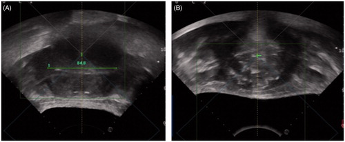 Figure 1. Plain US images collected (A) before and (B) after HIFU treatment show the difference in fibroid ecogenicity. In (B) disomogeneous hyperchoic changes of treated fibroid are visible.