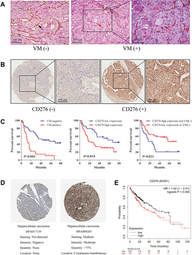 Figure 1 CD276 associated with vasculogenic mimicry and poor prognosis in HCC. (A) Representative images showing typical malignant morphology of vasculogenic mimicry by CD31/PAS staining in HCC. The black arrow indicates blood vessels formed by endothelial cells (PAS-/CD31+); The red arrows indicate the VM vessel (PAS+/CD31-). (B) The expression of CD276 in HCC tumor tissue microarrays was detected by immunohistochemical staining. HCC tumor sections with a final score of ≤3 were defined as low CD276 expression (CD276-), whereas sections with a final score of >3 were defined as high CD276 expression (CD276+). (C) Kaplan–Meier survival analysis showed that patients with VM had a shorter survival period than those without VM (p<0.001) and those with a high CD276 expression had a shorter survival period than those with a low CD276 expression (p=0.010). Patients with VM (+) and high CD276 expression had worse prognosis when compared with those with VM (-) or low CD276 expression (p=0.021). (D) Immunohistochemistry staining for CD276 in hepatocellular carcinoma tissue from a Human Protein Atlas Portal. (E) The prognostic value of the mRNA expression of CD276 in www.kmplot.com. Patients with liver cancer exhibiting a high mRNA expression of CD276 had a worse prognosis when compared to those with low expression levels.