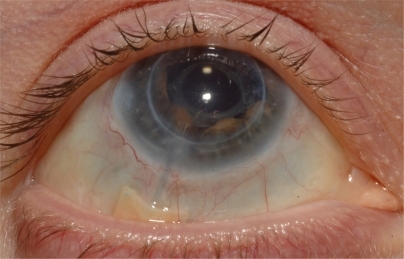 Figure 4 Postoperative appearance of optimal glaucoma drainage device tube position in anterior chamber.