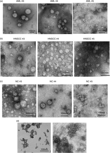 Fig. 2.  Transmission electron microscopy (TEM) of vesicles eluted in mini-SEC fractions #3, #4 and #5. Following mini-SEC of (a) AML plasma, (b) HNSCC plasma and (c) NC plasma, TEM was performed. Unconcentrated aliquots of vesicle-containing fractions were placed on grids and negatively stained with uranyl acetate. Note the presence of single exosomes in the size range of 30–100 nm. (d) Exosome aggregates present in #5 fractions of HNSCC and AML plasma are shown. Representative images from 1 of 6 experiments performed are presented. AML=acute myeloid leukaemia; HNSCC=head and neck squamous cell carcinoma; NC=normal control.